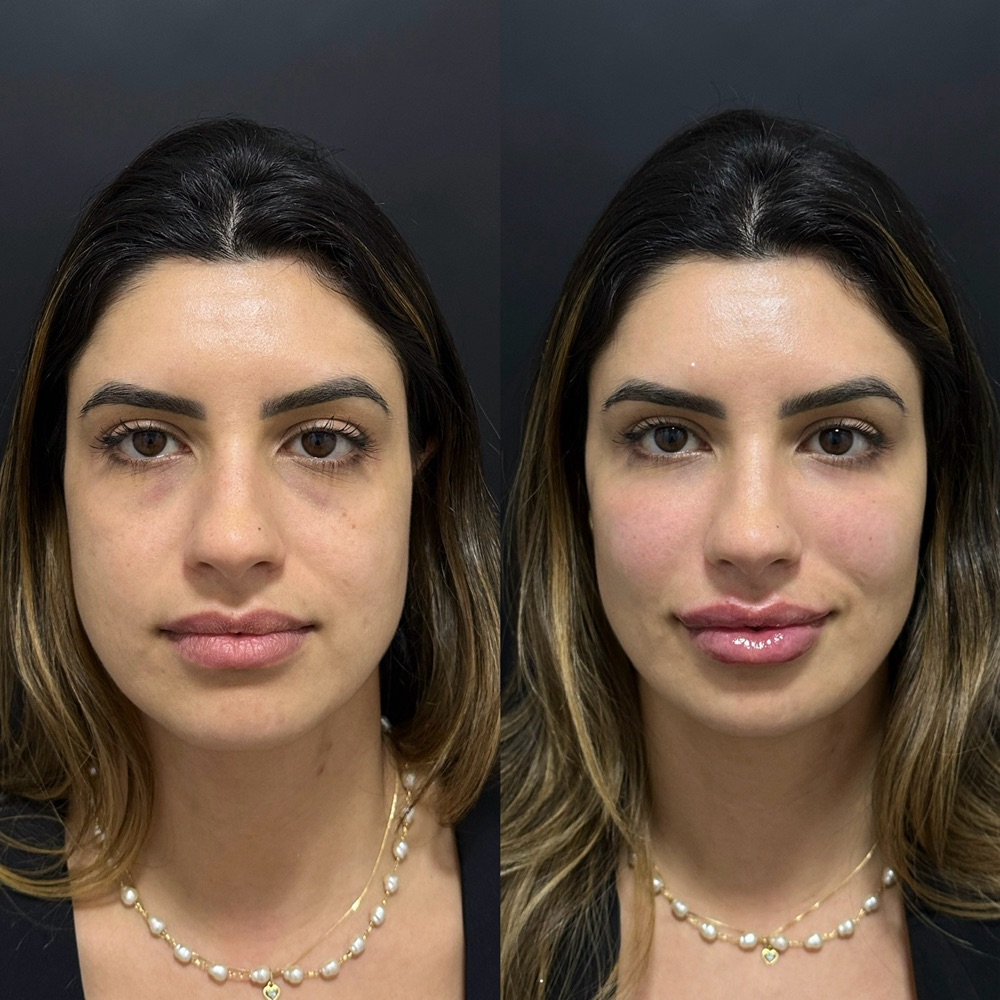 Antes e depois de harmonização facial e preenchimento labial com a Dra. Vitória Ribeiro em Joinville