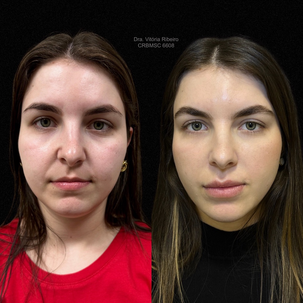 Resultado de harmonização facial antes e depois, paciente da Dra. Vitória Ribeiro