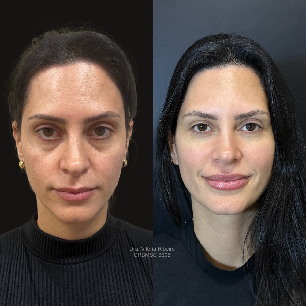 Antes e depois de harmonização facial com resultado natural, Dra. Vitória Ribeiro