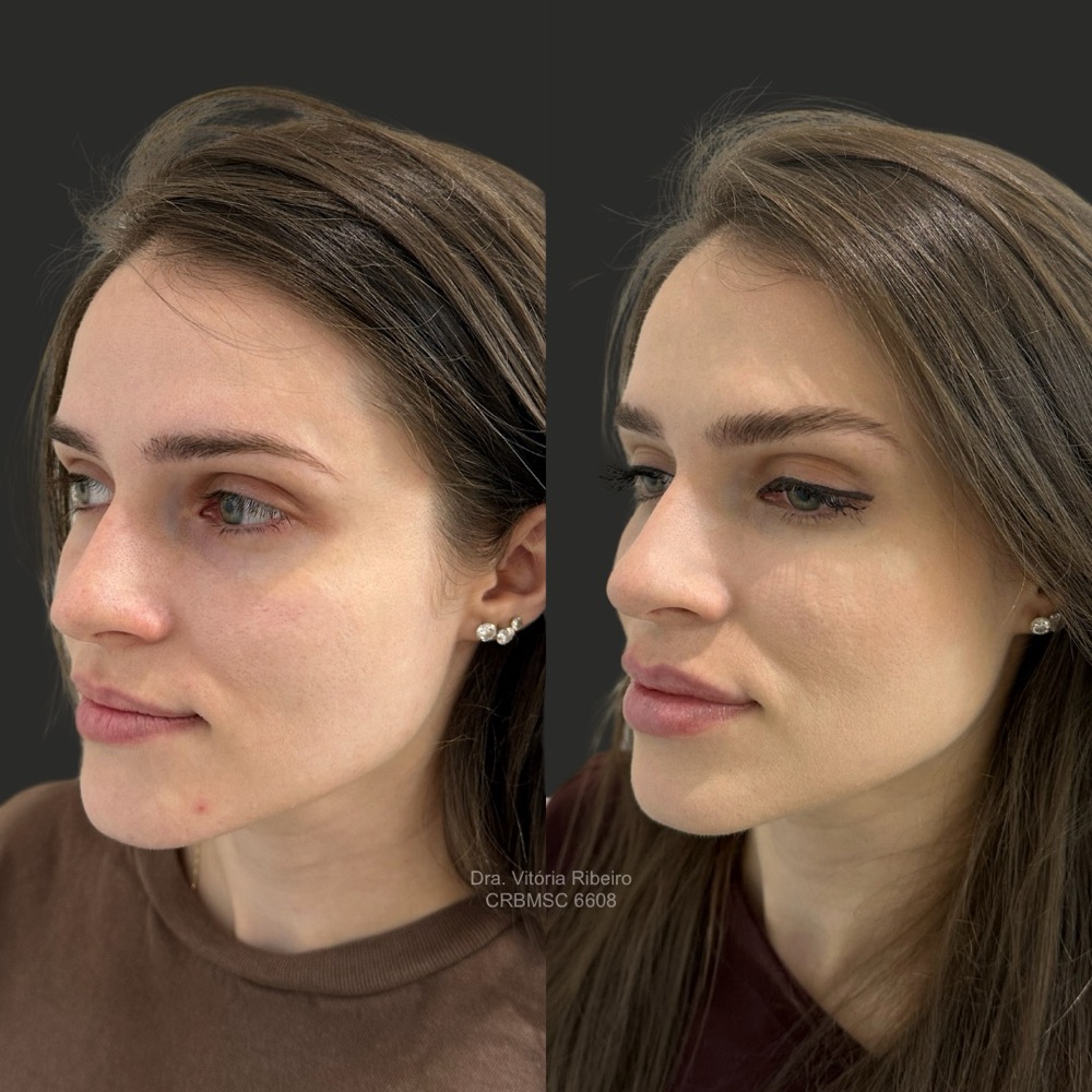 Harmonização facial antes e depois em perfil, paciente da Dra. Vitória Ribeiro em Joinville